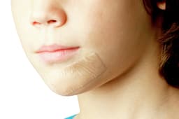 Scar Repair application-Scar Repair application child chin