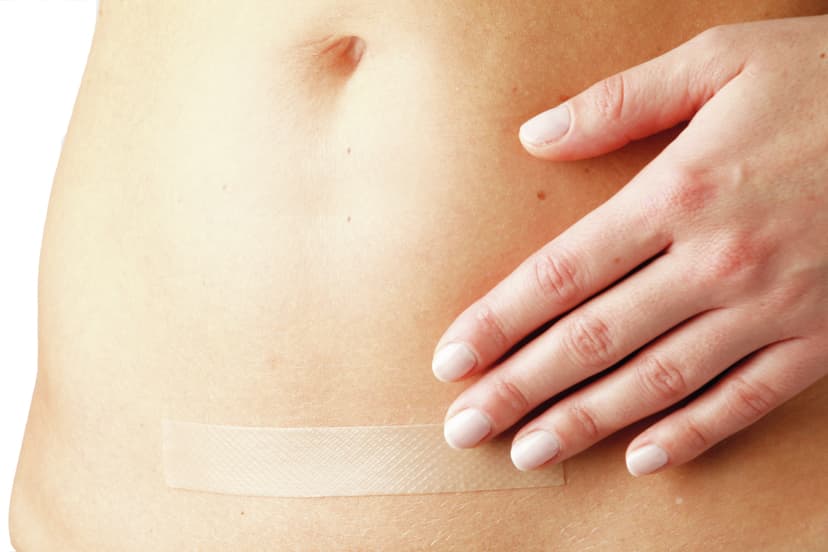 Scar Repair application-Scar Repair application caesarean 1