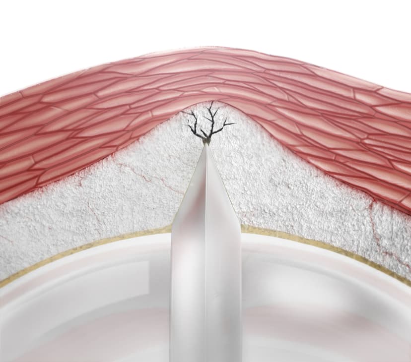 NSE PTA Aperta-PTA High Pressure Scoring Balloon Catheter